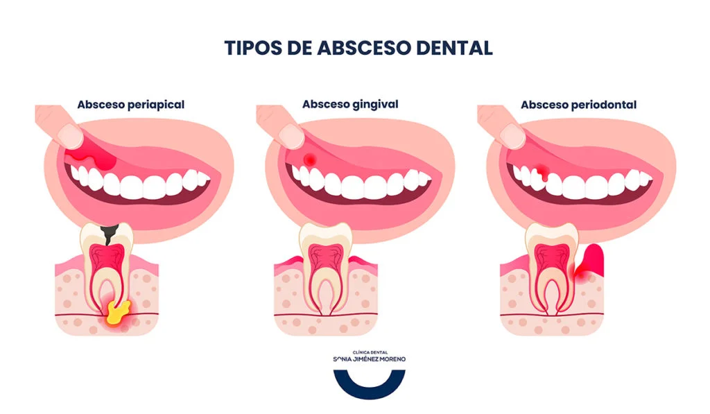 ir al dentista por una muela del juicio
